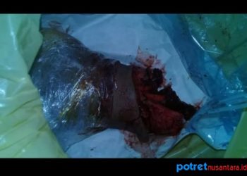 Kondisi kaki yang patah