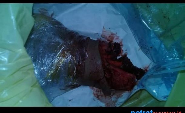 Kondisi kaki yang patah