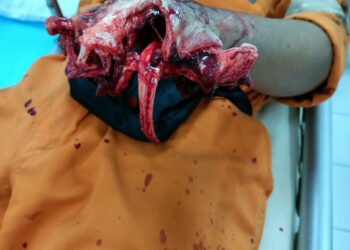 Tangan Hancur Tertimpa Pipa Saat Buka Clamp Lashing, Karyawan Saipem Dilarimun Ke Rumah Sakit