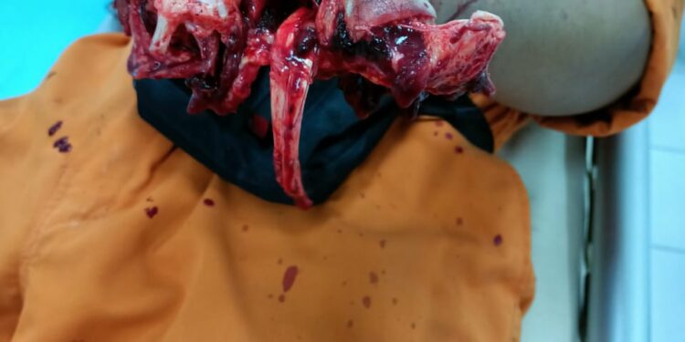 Tangan Hancur Tertimpa Pipa Saat Buka Clamp Lashing, Karyawan Saipem Dilarimun Ke Rumah Sakit