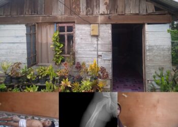 Patah Tulang, Bocah Di Pangke Barat Butuh Bantuan Untuk Operasi